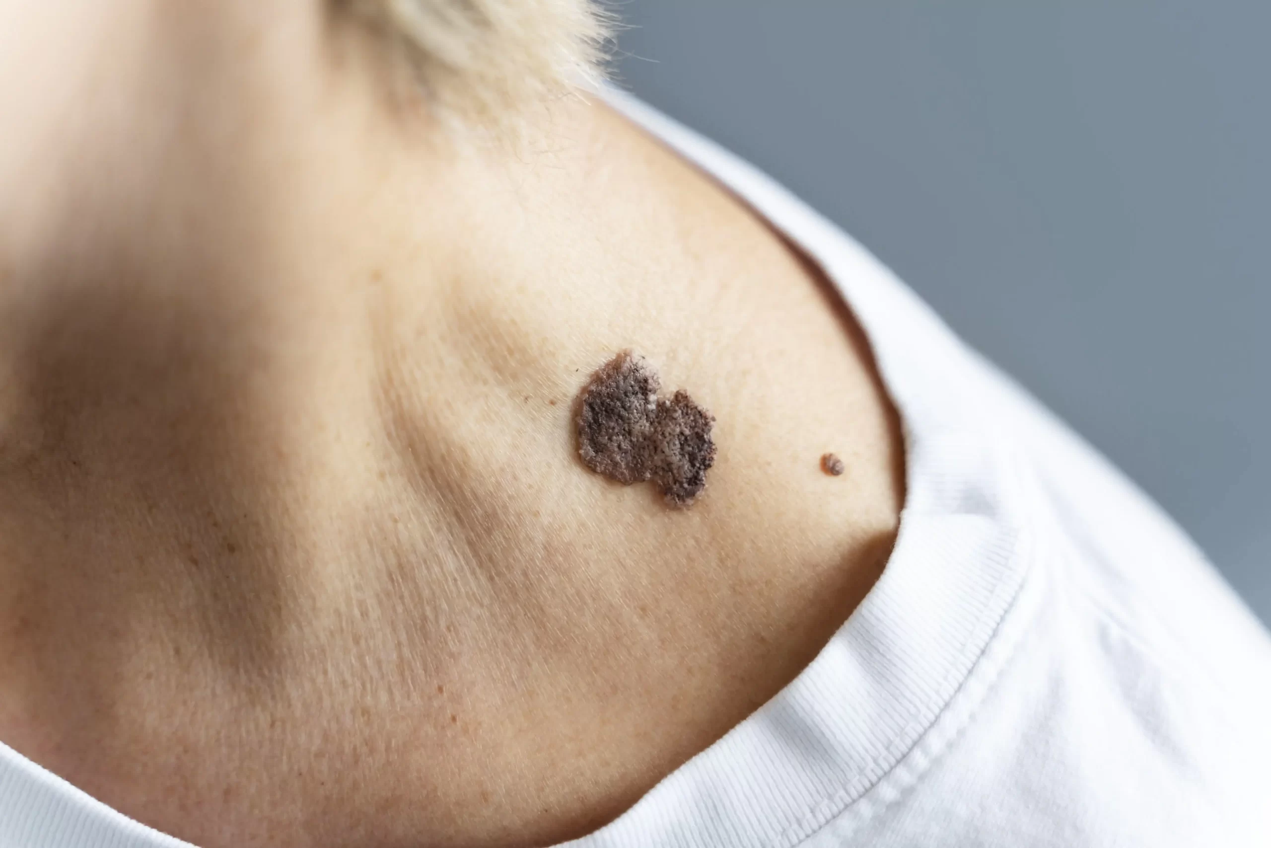Anyajegyszűrés: minden, amit tudnod kell a melanoma megelőzéséről