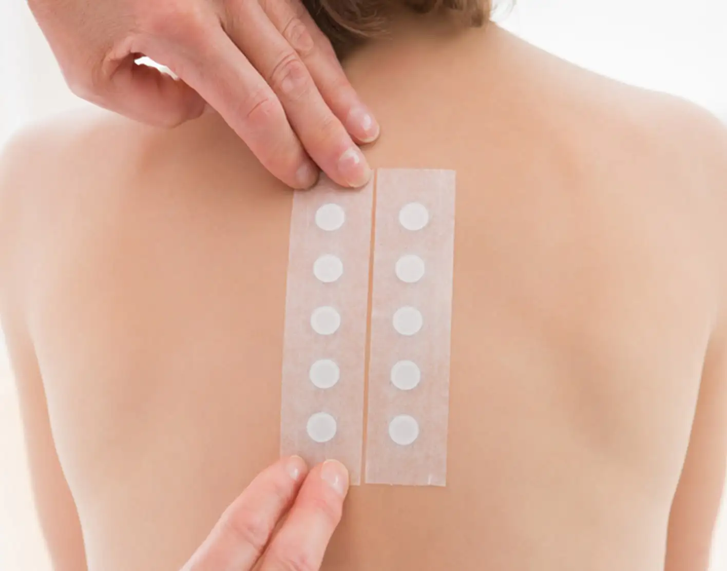 Fémallergia diagnosztizálása epicutan allergiateszt segítségével